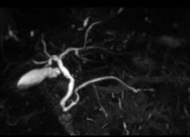 胆管膵管撮像